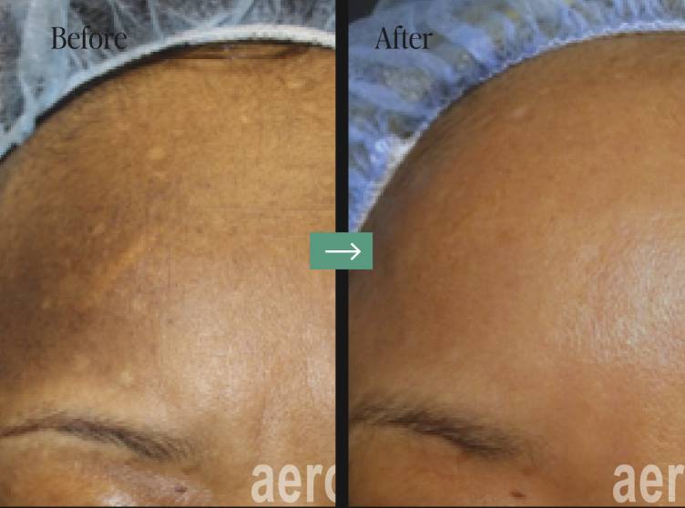 Aerolase Laser Before and After Pictures Charleston County, SC